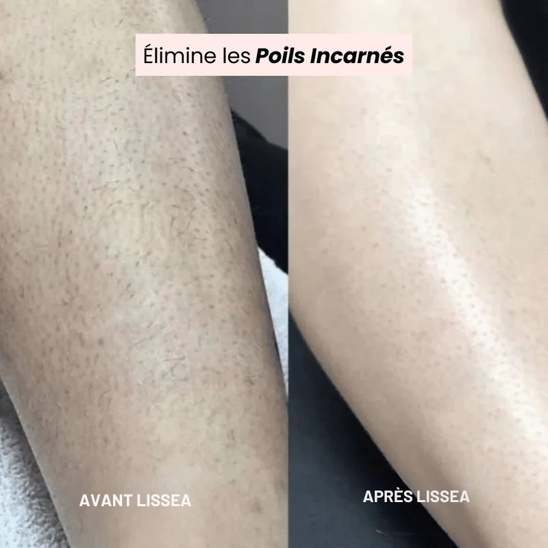 Lissea™ – Le rasage tout en douceur qui révèle la vraie beauté de votre peau.