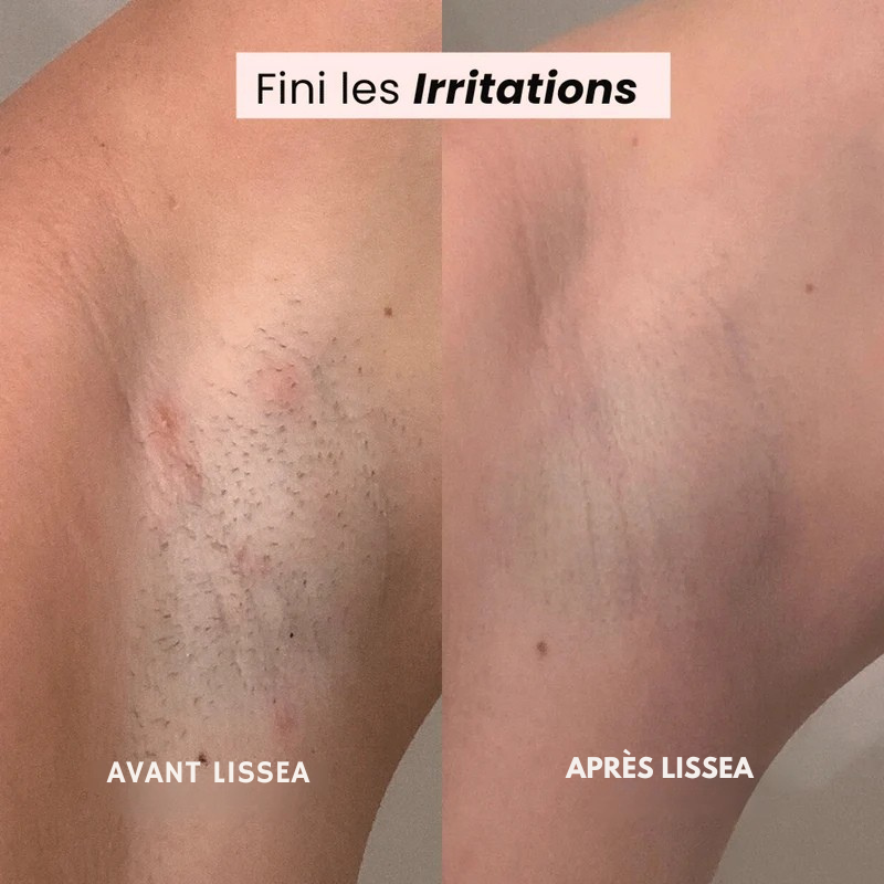 Lissea™ – Le rasage tout en douceur qui révèle la vraie beauté de votre peau.